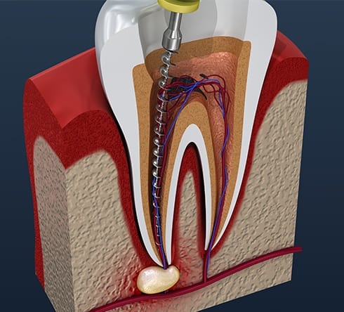Animated root canal therapy process