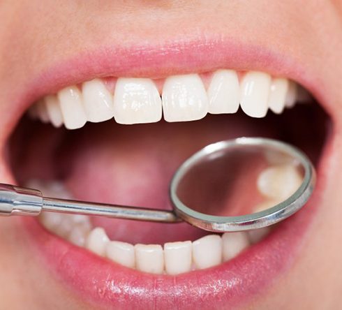 Teeth examined with dental mirror