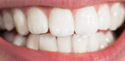 Smile after teeth whitening