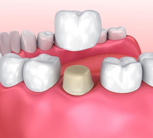 A 3D illustration of a dental crown hovering over a tooth