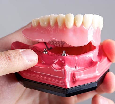 Model dental implant supported denture