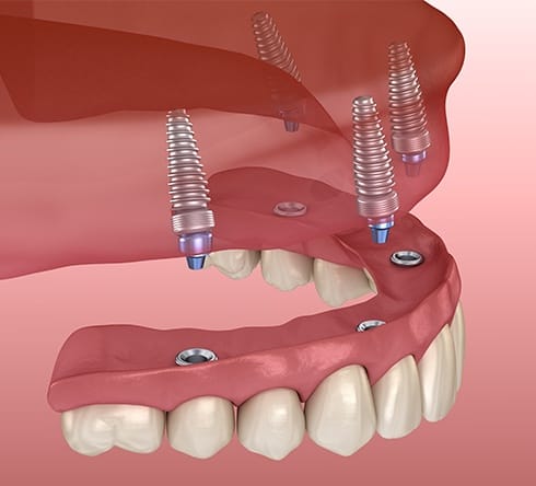 Animated dental implant supported denture placement