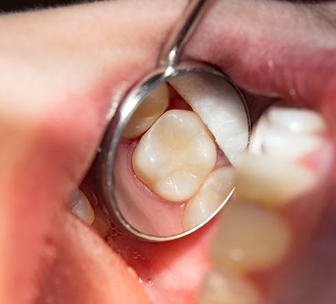 An example of a composite resin tooth-colored filling 