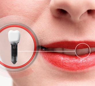 close-up of a patient with a dental implant