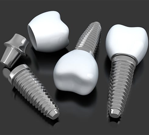 Three animated dental implant supported replacement teeth