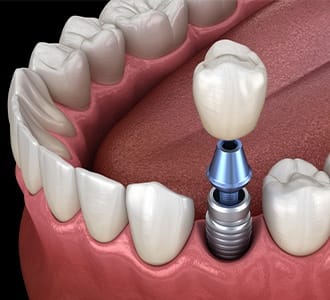 Animated dental implant supported dental crown