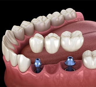 Animated dental implant supported fixed bridge