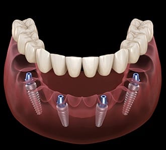 Animated dental implant supported denture