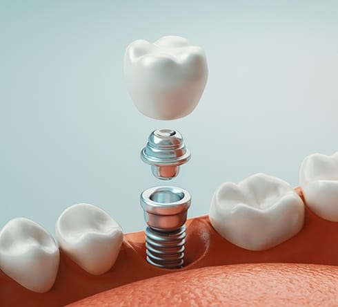 Animated dental implant supported dental crown placement