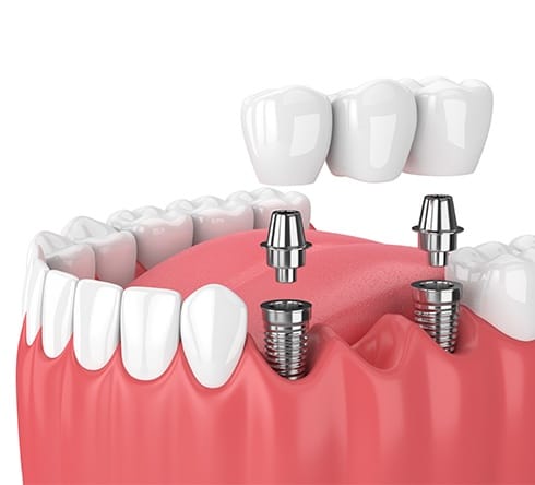 Animated dental implant supported fixed bridge placement