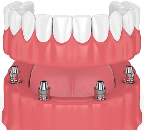 Animated dental implant supported denture placement