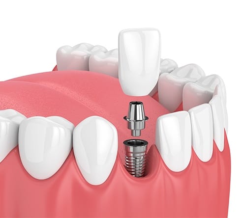 Animated dental implant supported dental crown placement