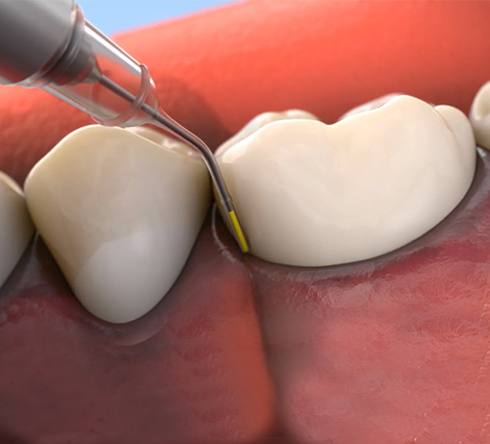 Animated topical antibiotic therapy