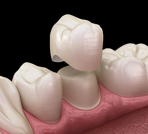 Animated dental crown placement