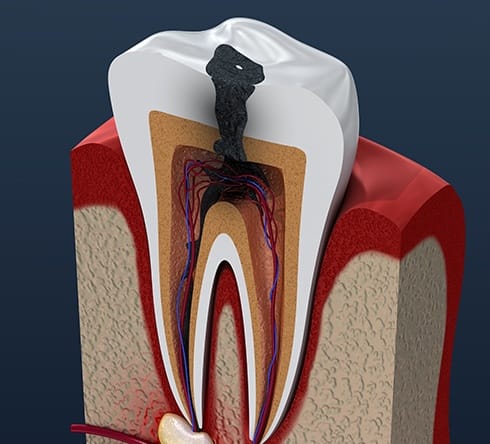 Animated tooth in need of root canal therapy