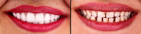 A smile after (left) and before (right) porcelain veneers