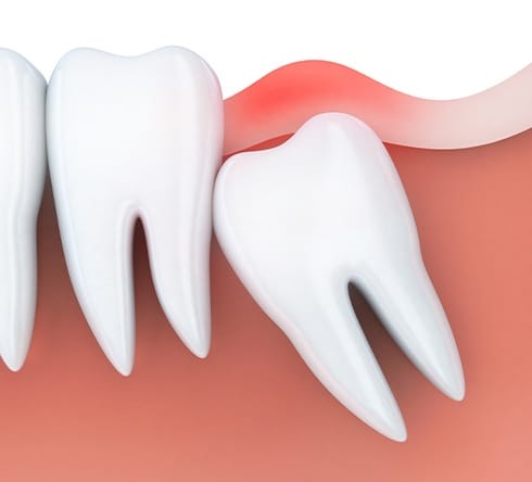 Animated smile with impacted wisdom tooth