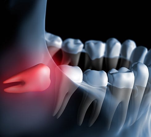 3 D rendering of impacted wisdom tooth in jaw line