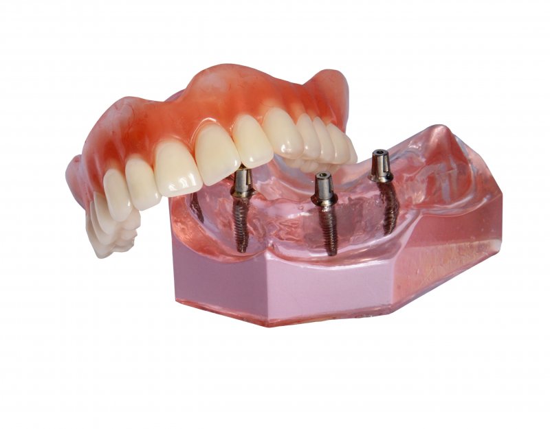 implant dentures 