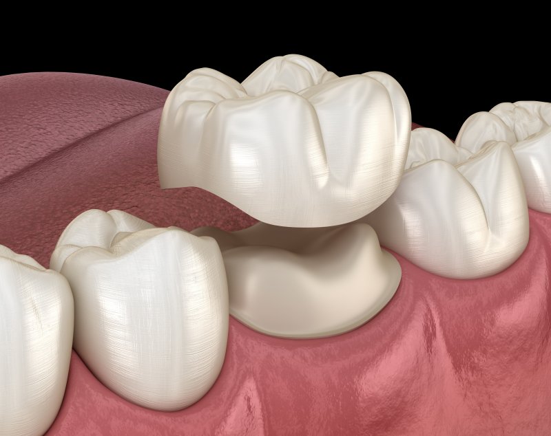 a tooth preparing to receive a dental crown 