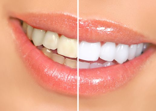 A woman’s smile before and after teeth whitening