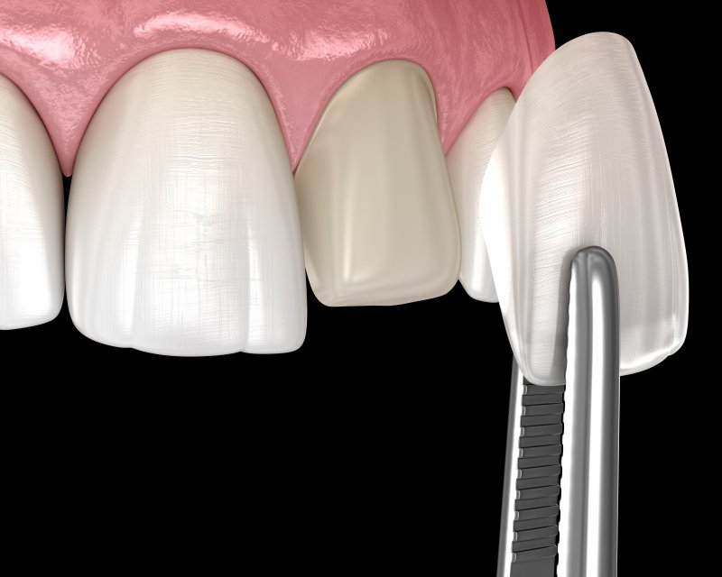digital image of veneer placement 